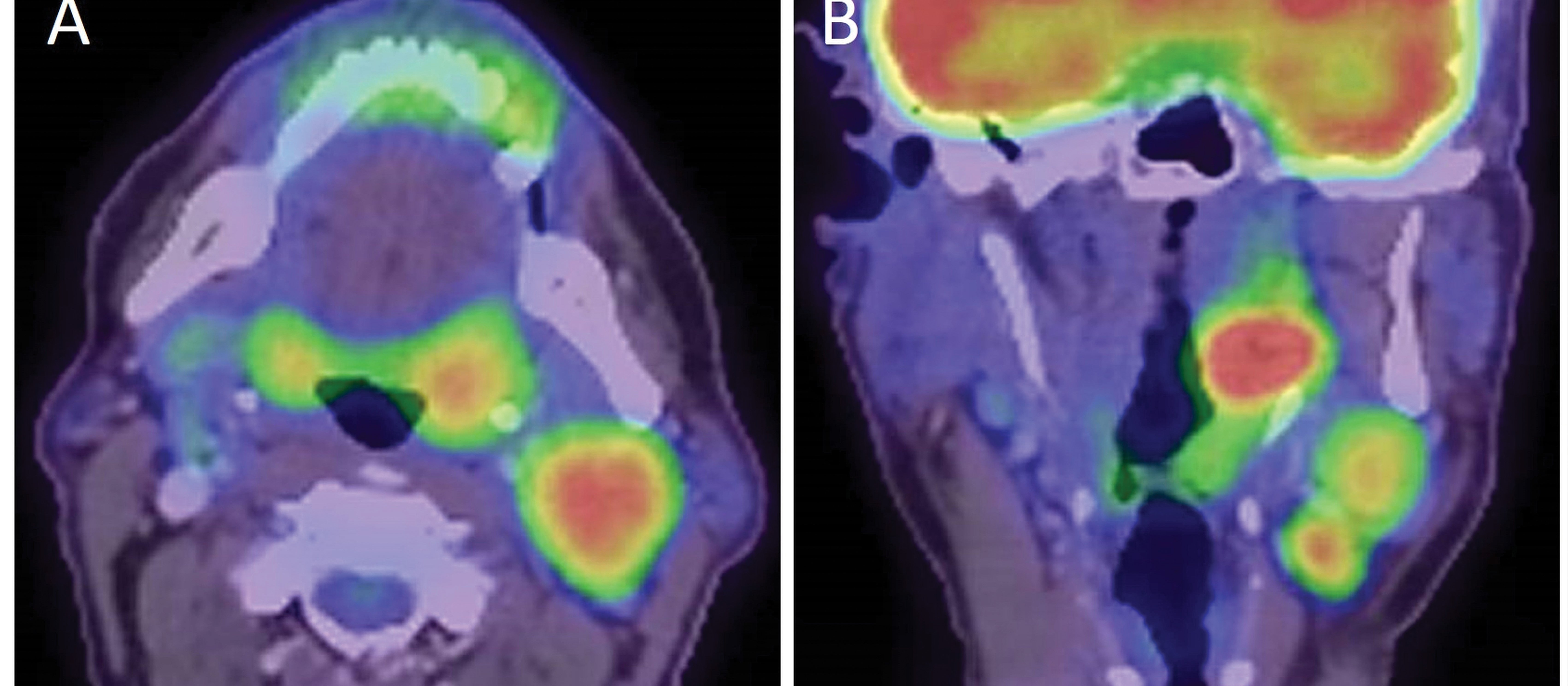 Figure 1. Axial (A) and coronal (B) PET-CT showing HPV-positive oropharyngeal squamous cell carcinoma affecting the left tonsil with metastases in the neck