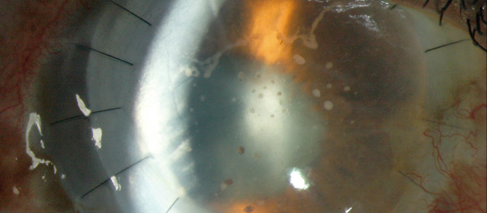Graft rejection after penetrating keratoplasty. The cornea is cloudy with oedema and scattered keratic precipitates. Confluent conjunctival injection and corneal neovascularisation are present