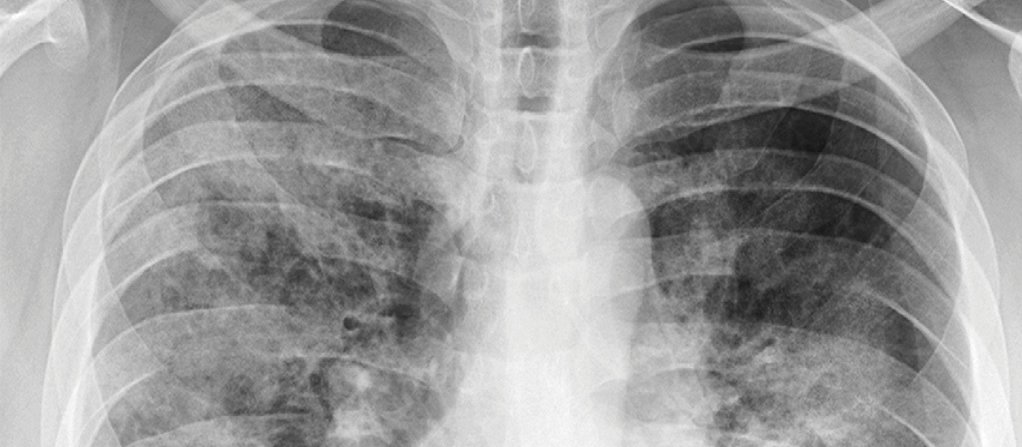 Other tests, such as chest x-rays to detect infection, add certainty to the diagnosis