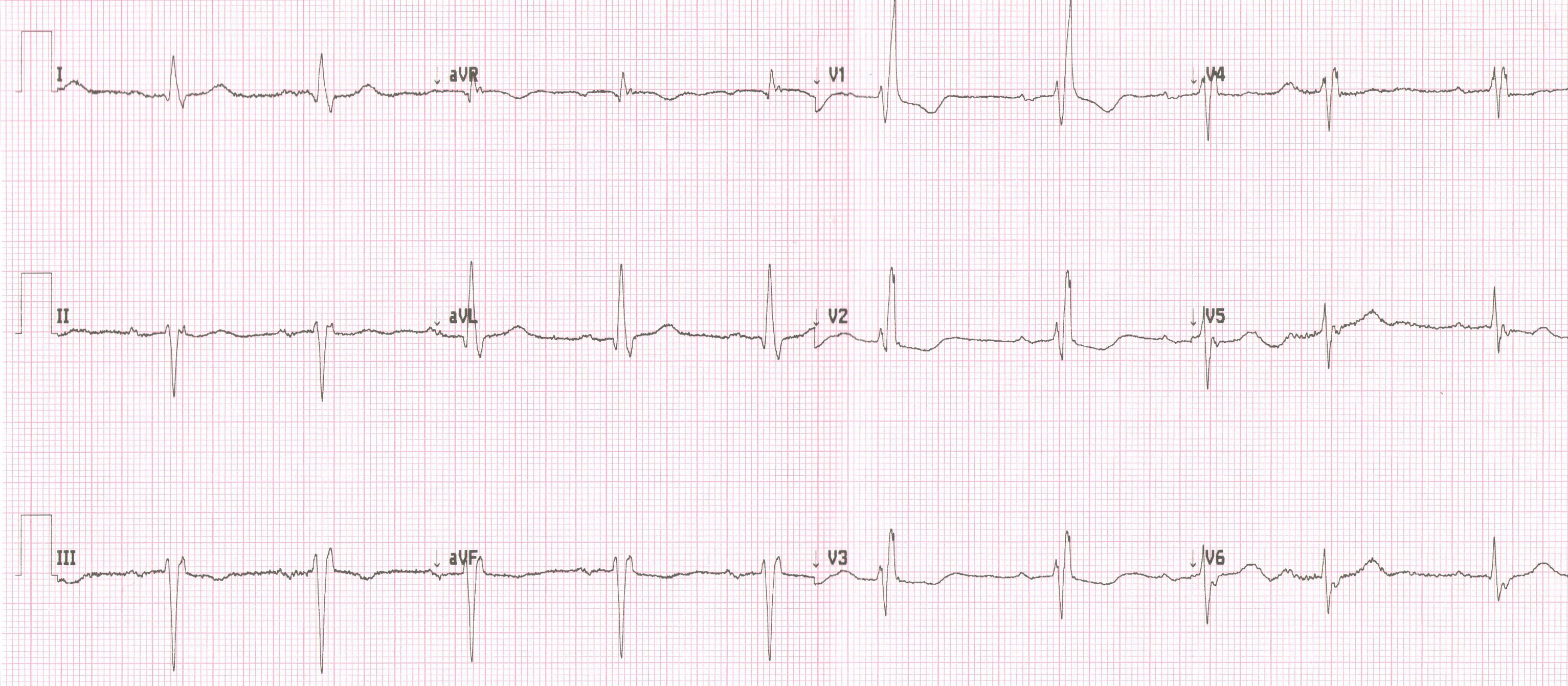 The term “trifascicular block” is a misnomer used to describe a combination of a right bundle branch block, an anterior (or posterior) left fascicular block and a first-degree atrioventricular block (a prolonged PR interval) 