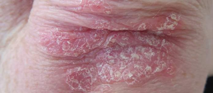 chronic plaque psoriasis