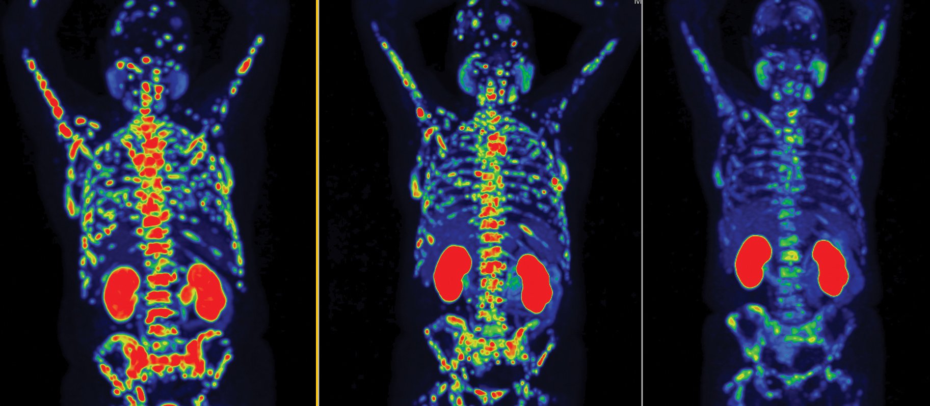 Progressive improvement in disease burden with lutetium-177 PSMA radioligand therapy. Left to right: baseline; midtreatment after two cycles; after four treatment cycles 