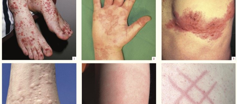 Adverse cutaneous reactions following COVID-19 vaccination 1-6