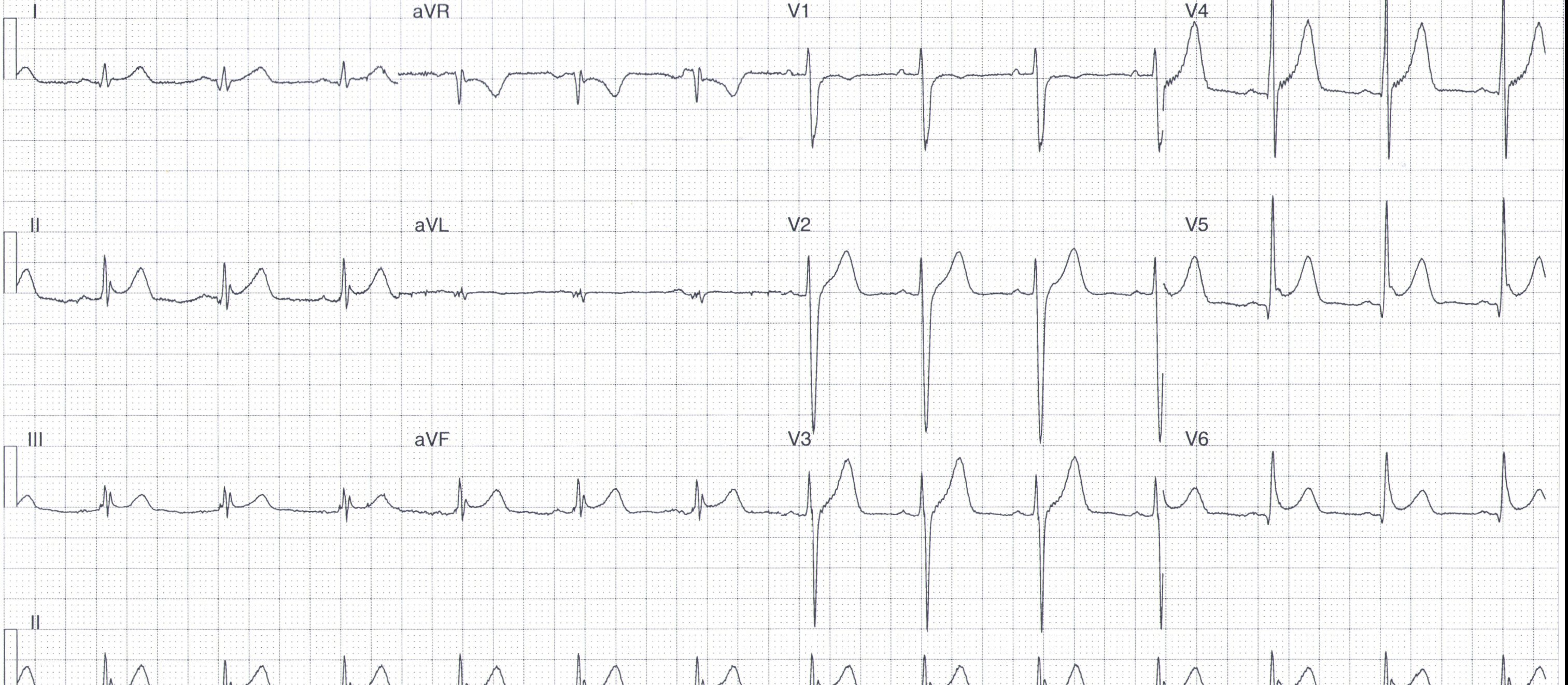 Heartbeat ECG