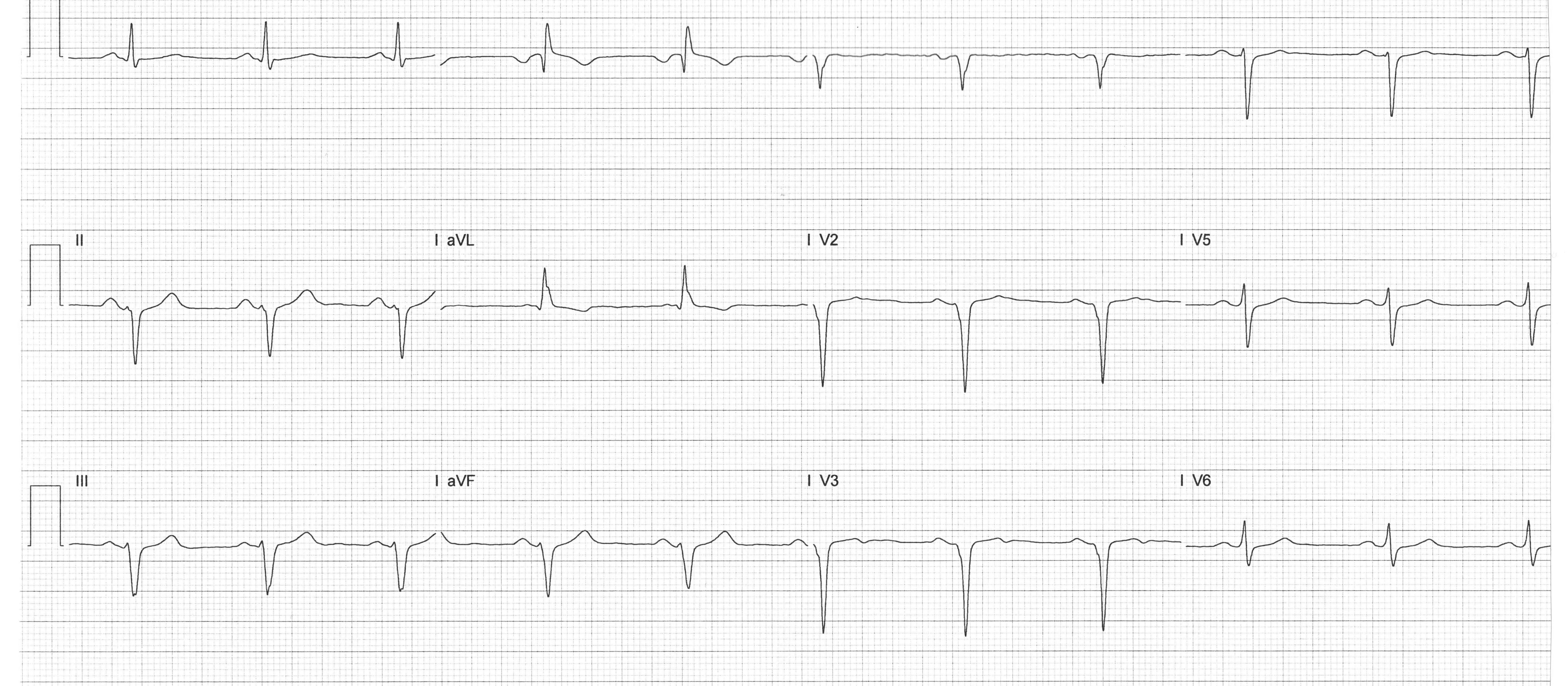 Heartbeat ECG 