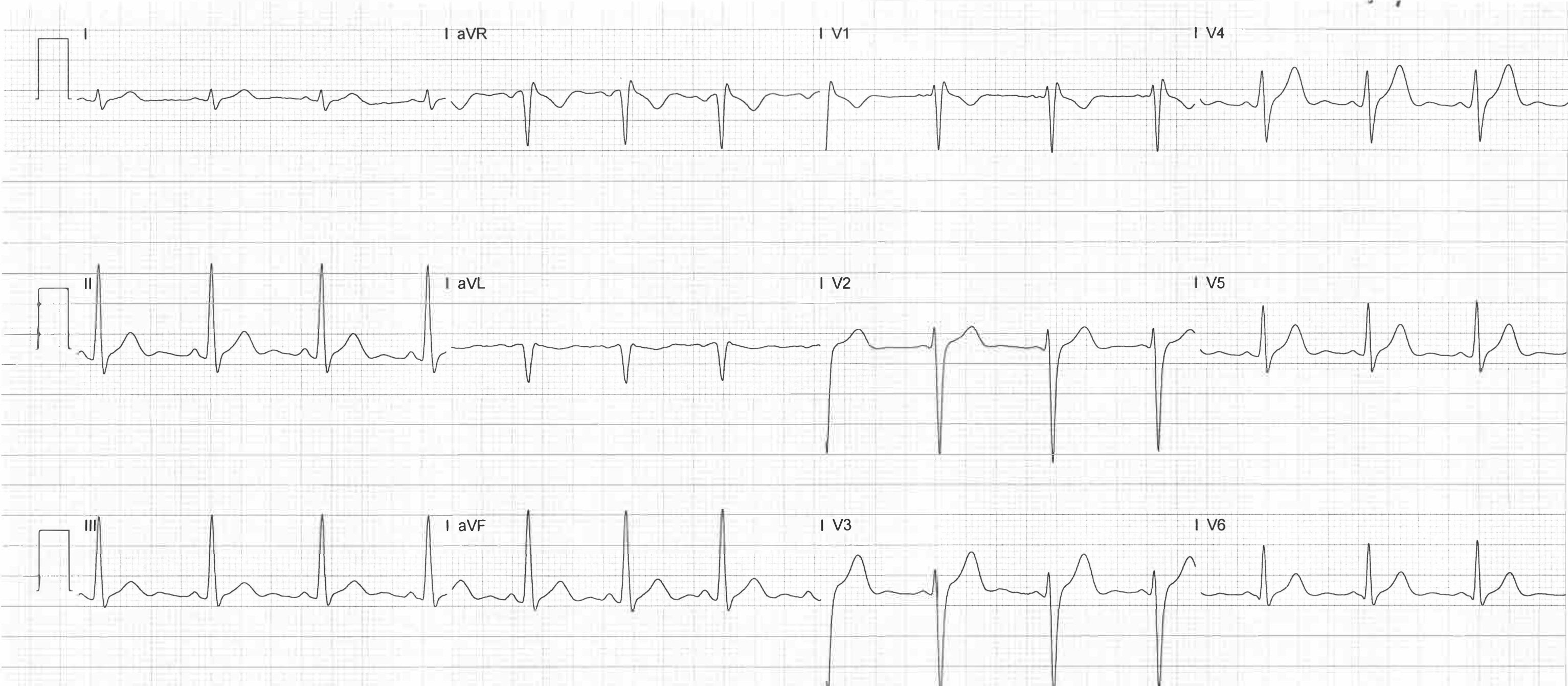 ECG