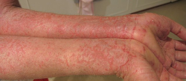 Eczema