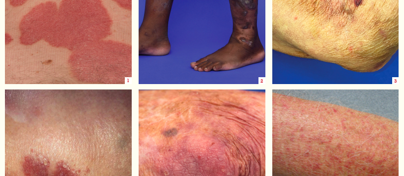 Examples of psoriasis