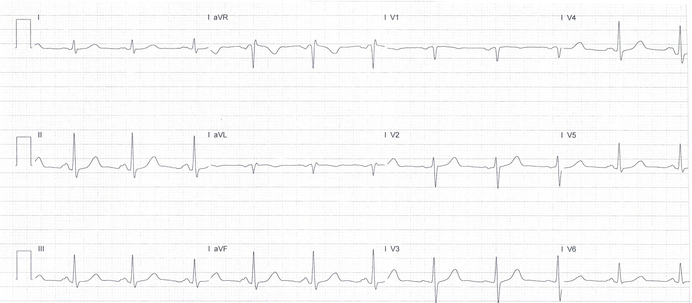 Heartbeat ECG