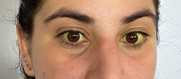 Jaundice following steroid weaning