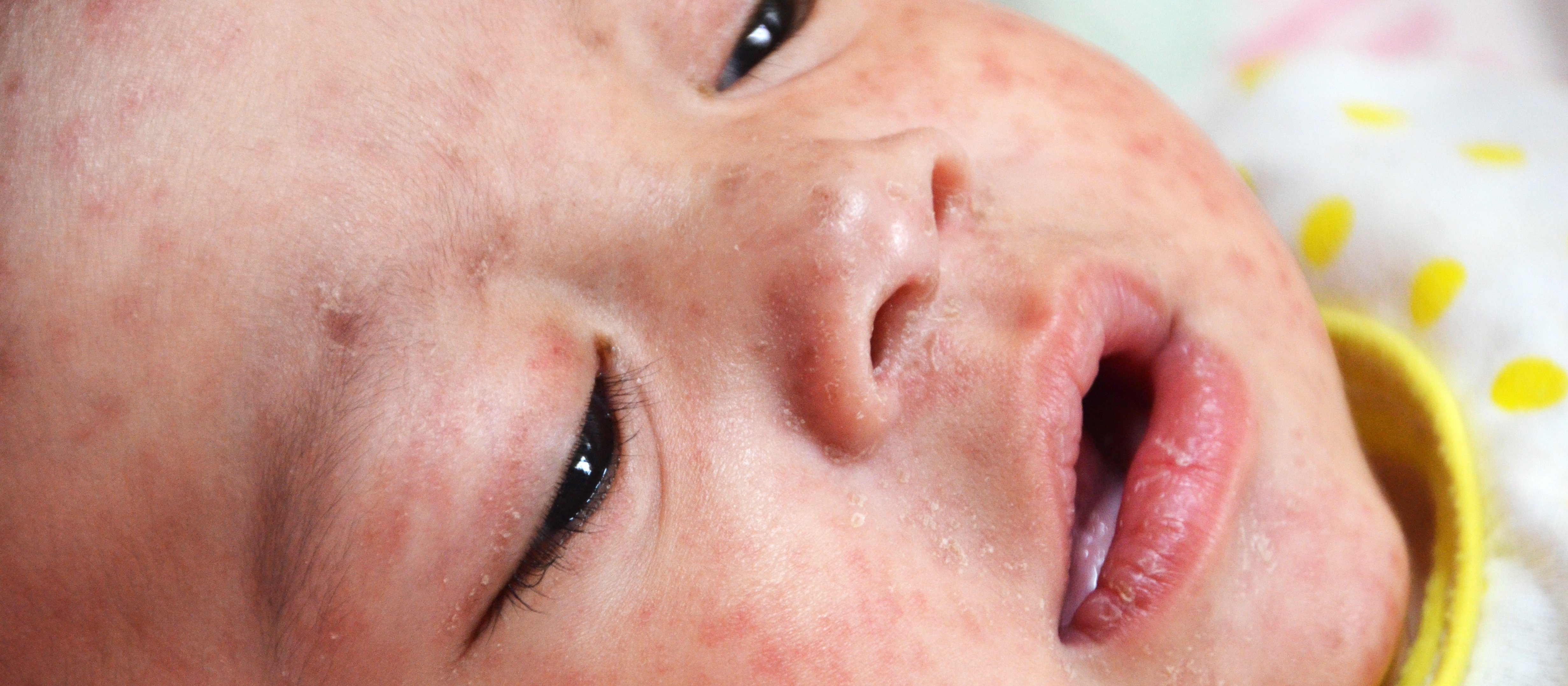 Baby with measles by Jim Goodson