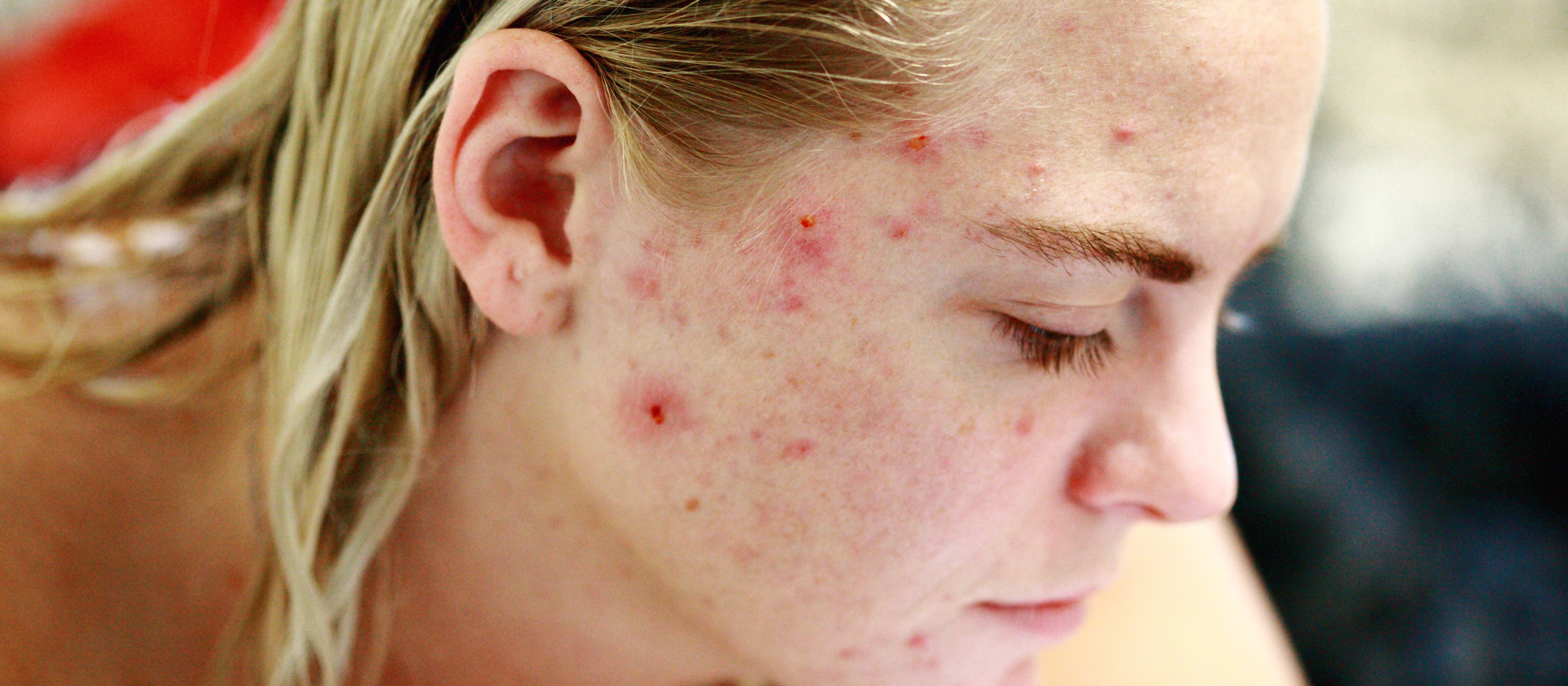 Young people acne