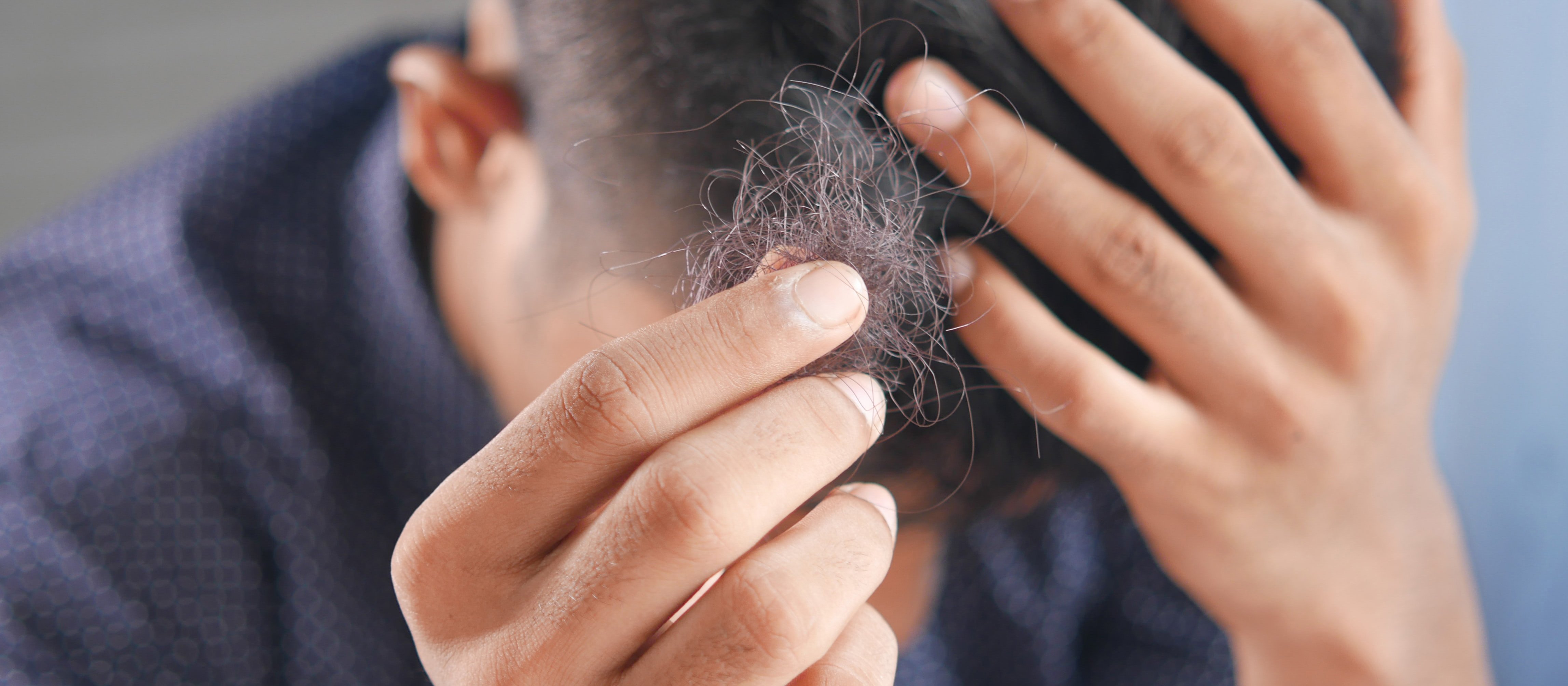 Hair Loss