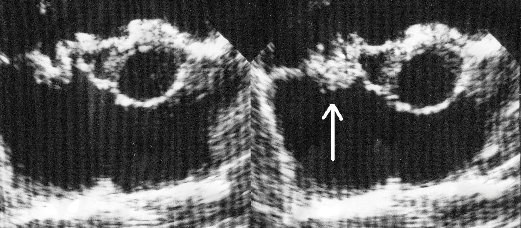 Echocardiogram