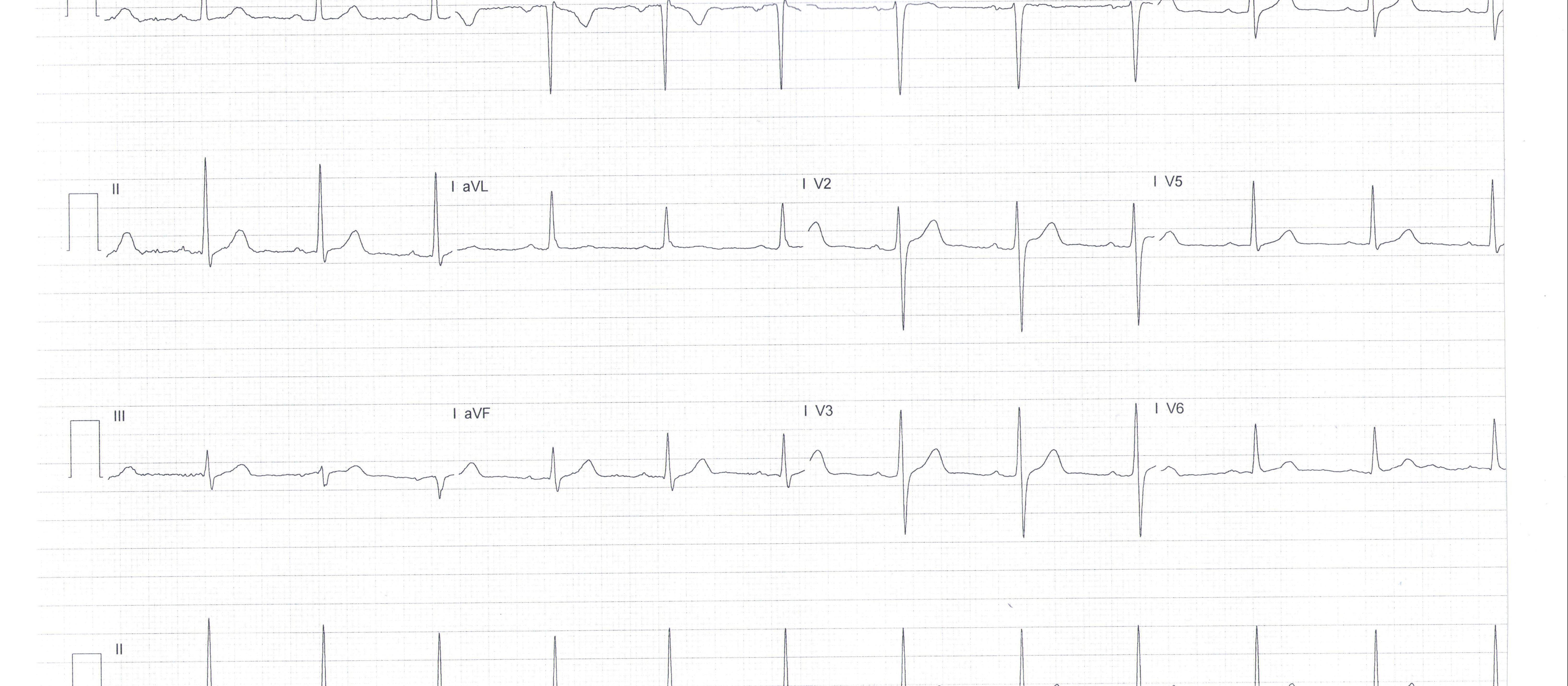 ECG