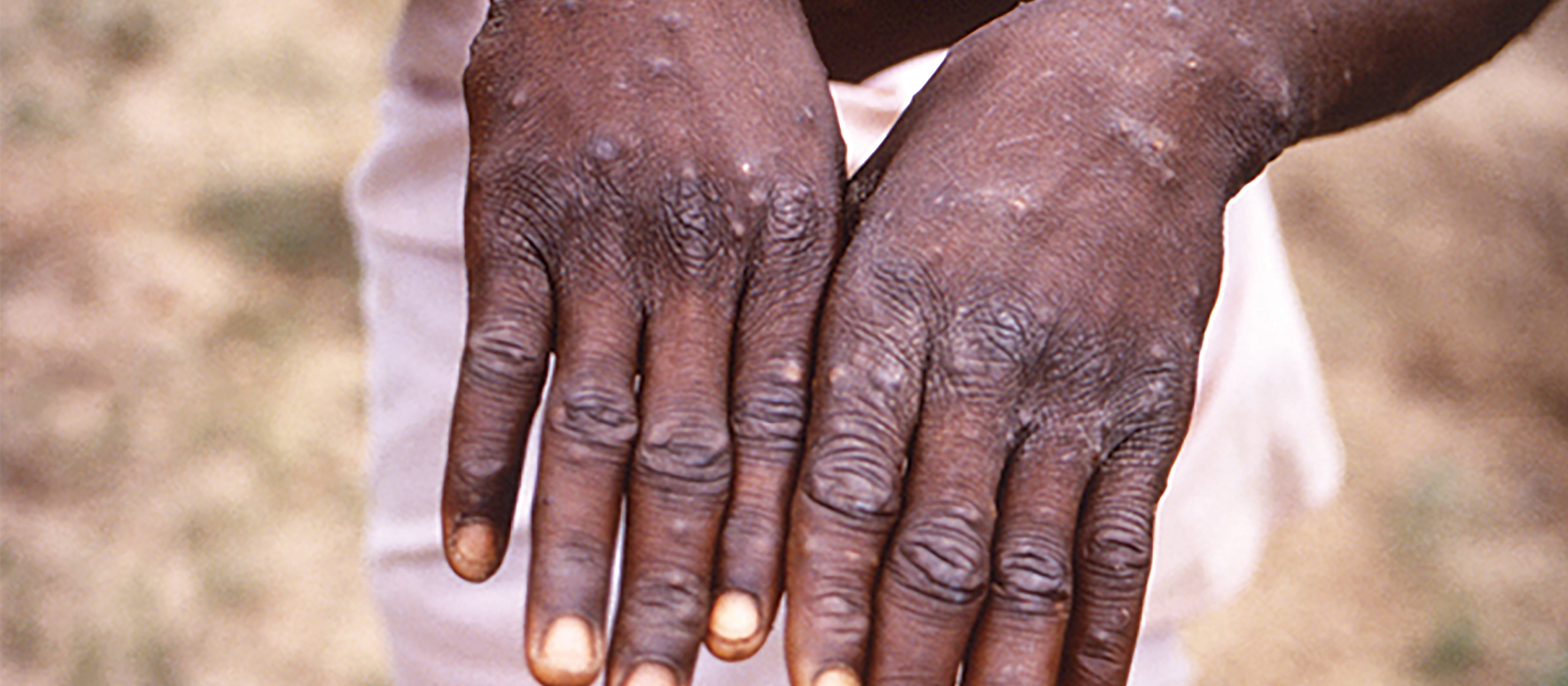 Monkeypox