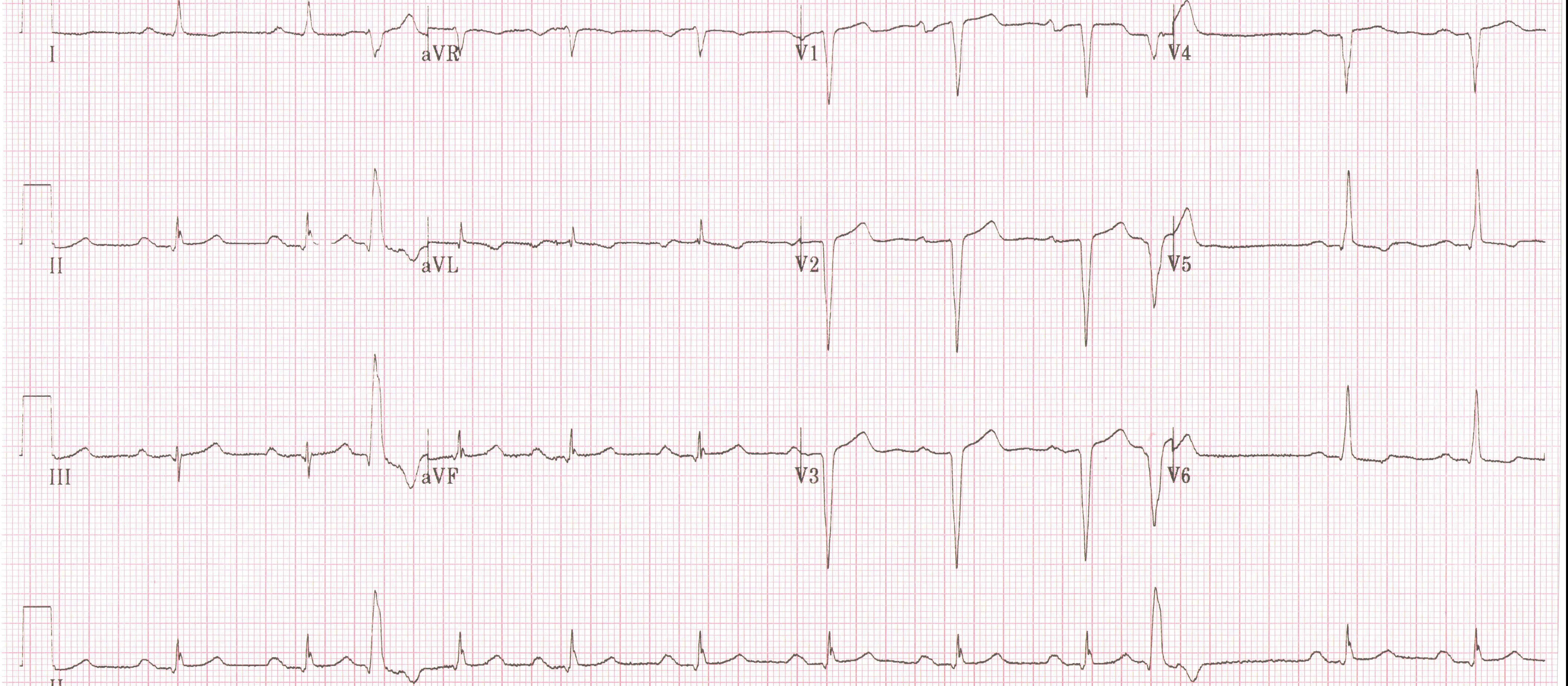 ECG
