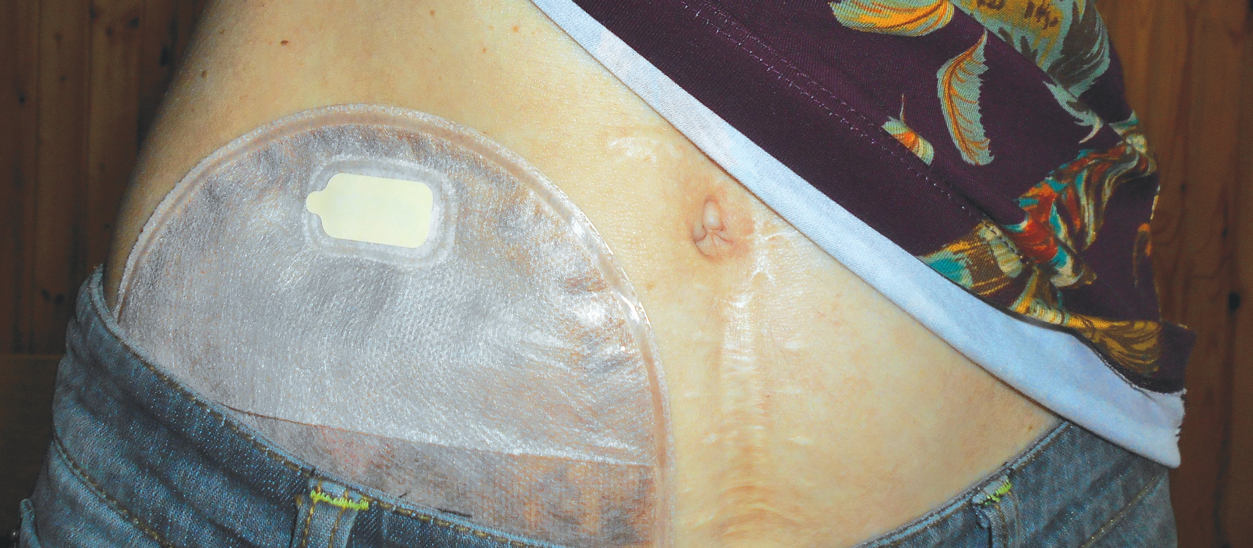 Ileostomy stoma bag 