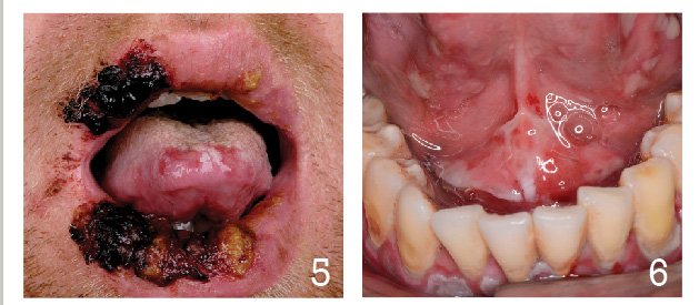 Mouth ulcers can be acute or chronic with an array of underlying