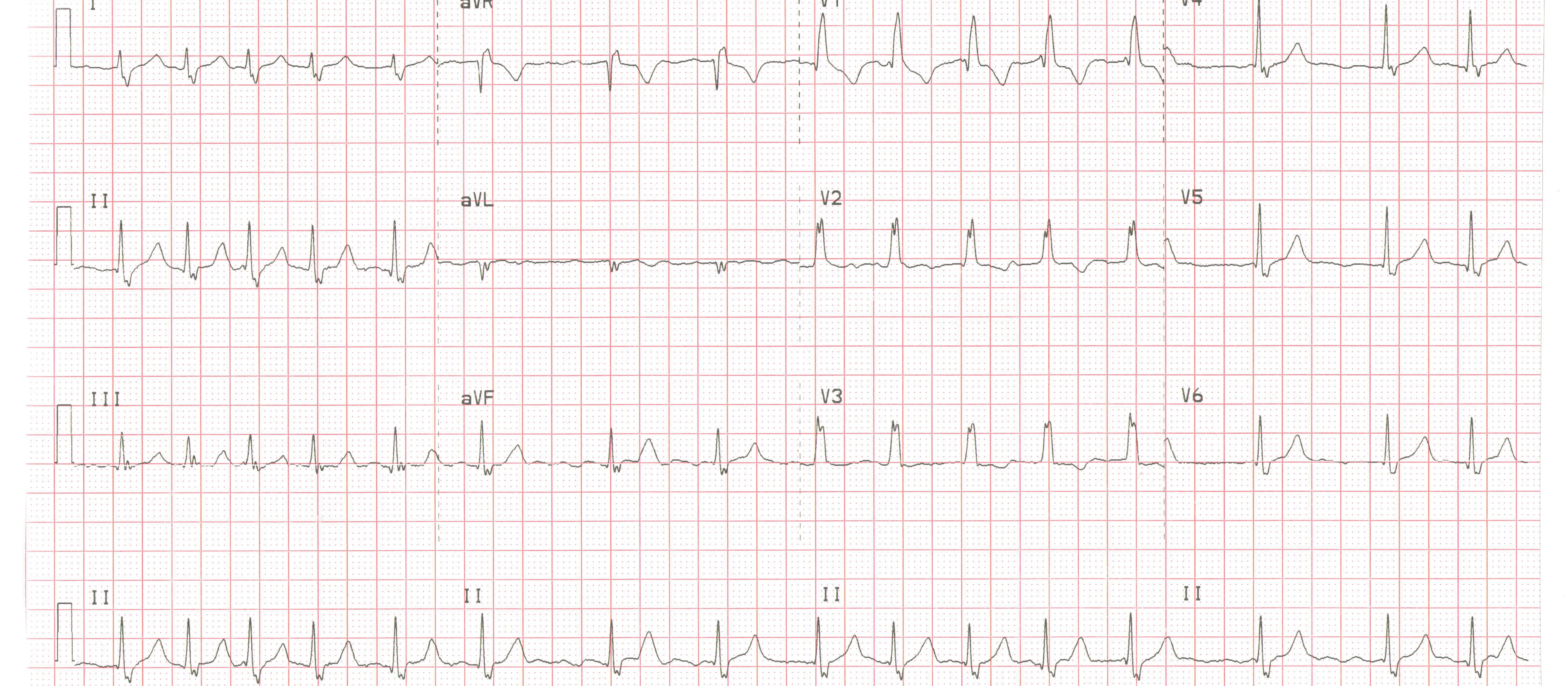 ECG
