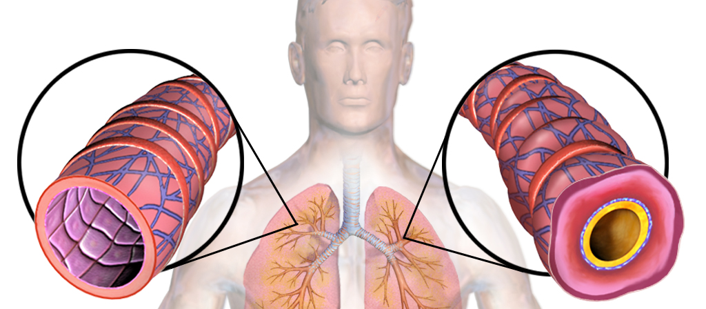 Asthma