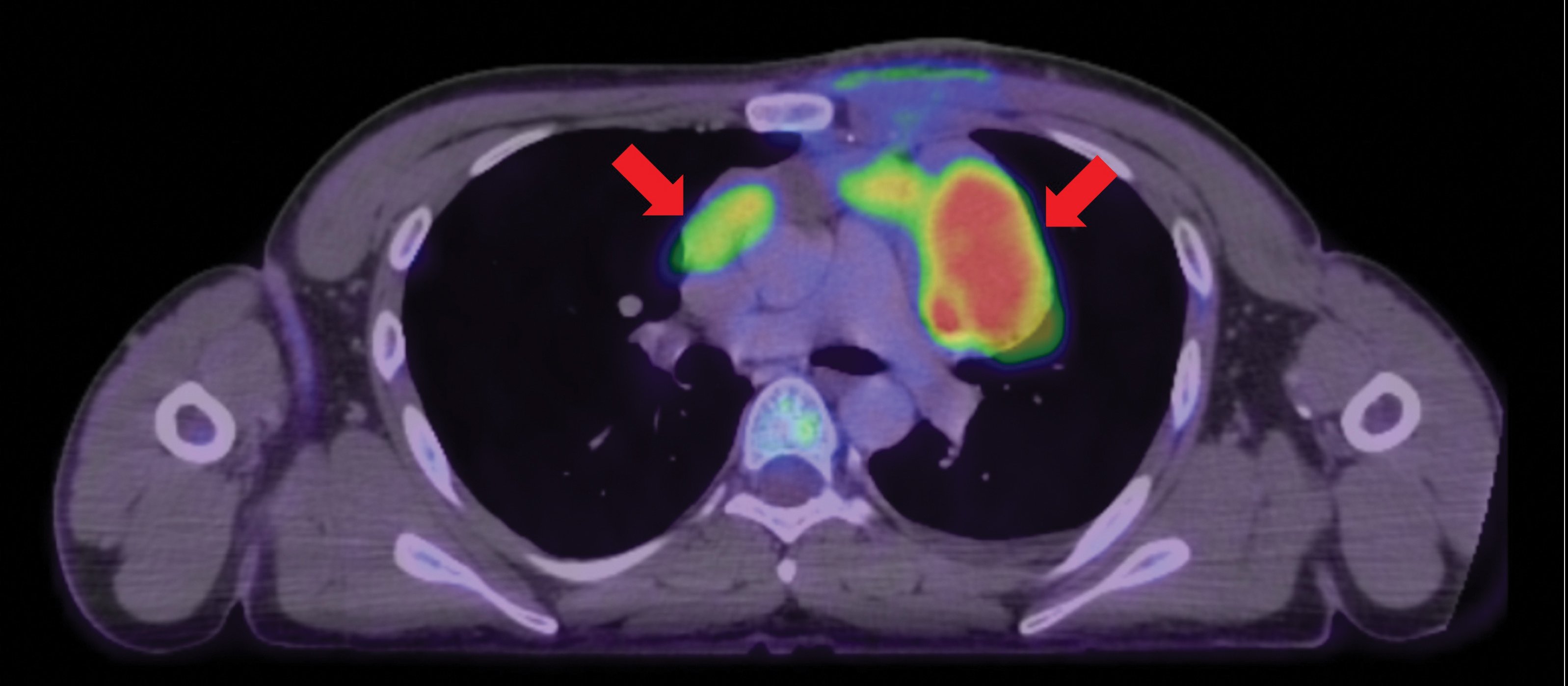 Fused PET and CT images