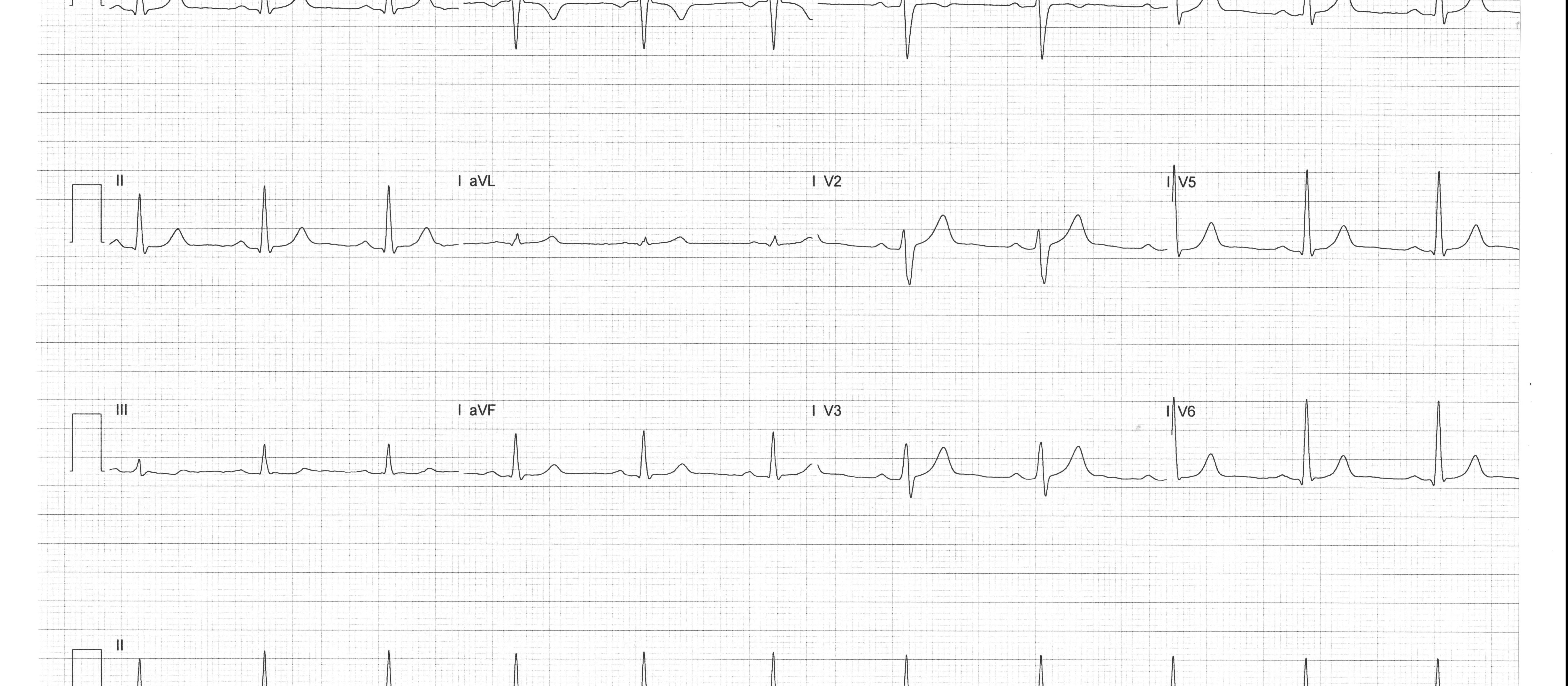 ECG