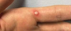 Monkeypox lesion