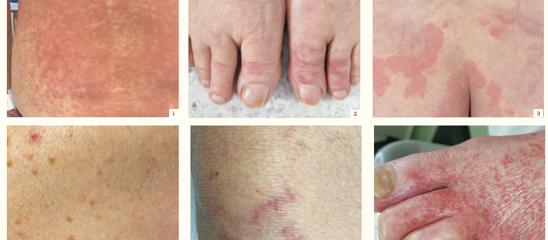 pandemic related skin problems