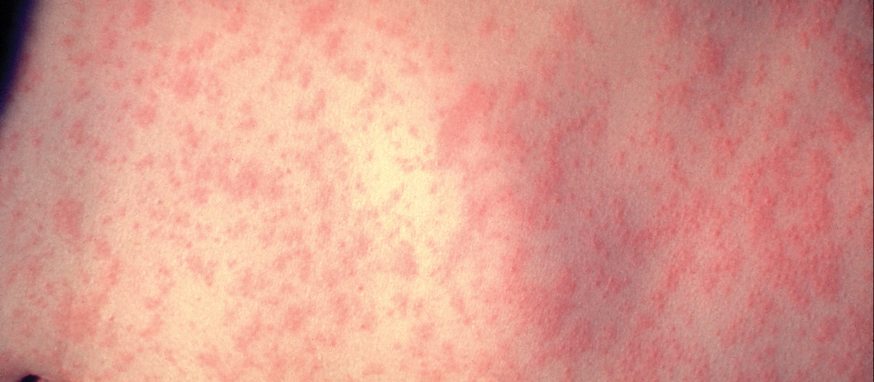 Figure 1. Characteristic maculopapular rash