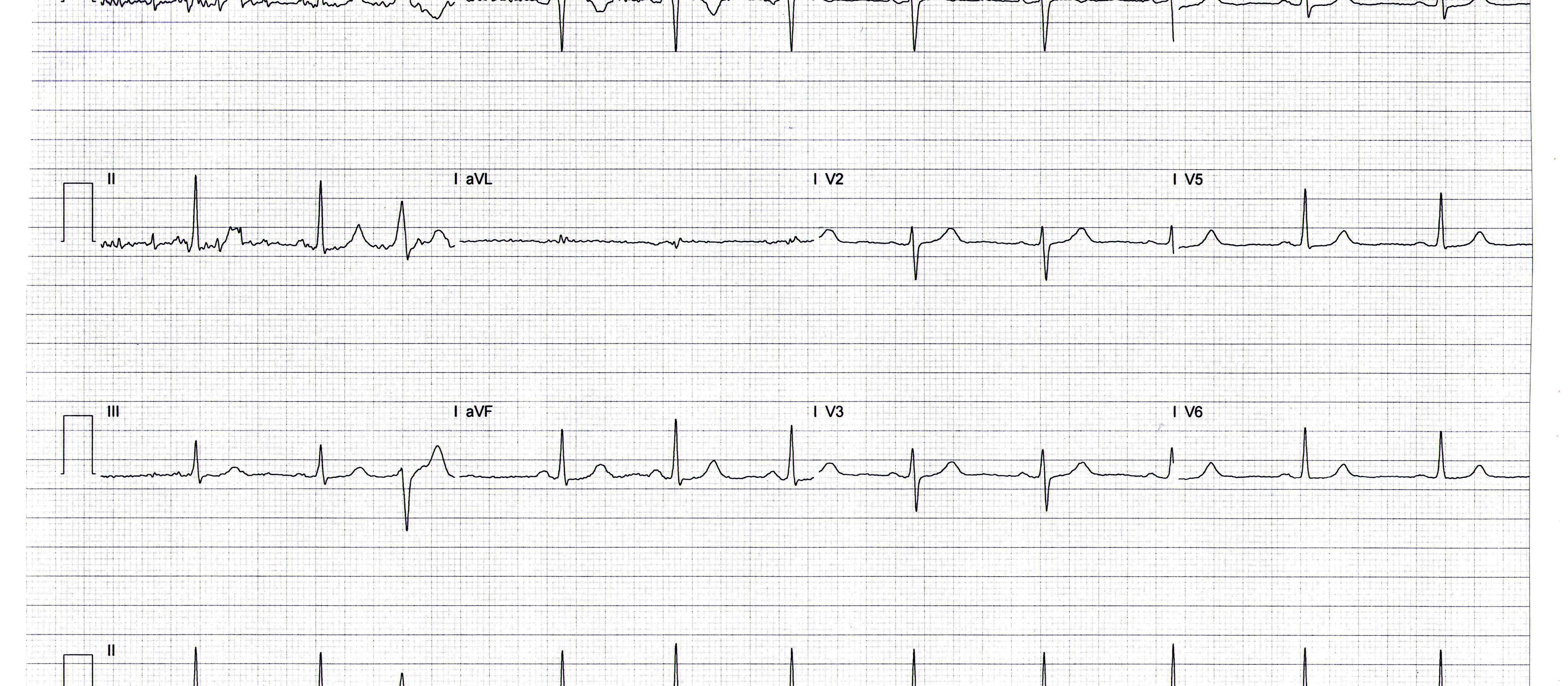 Heartbeat
