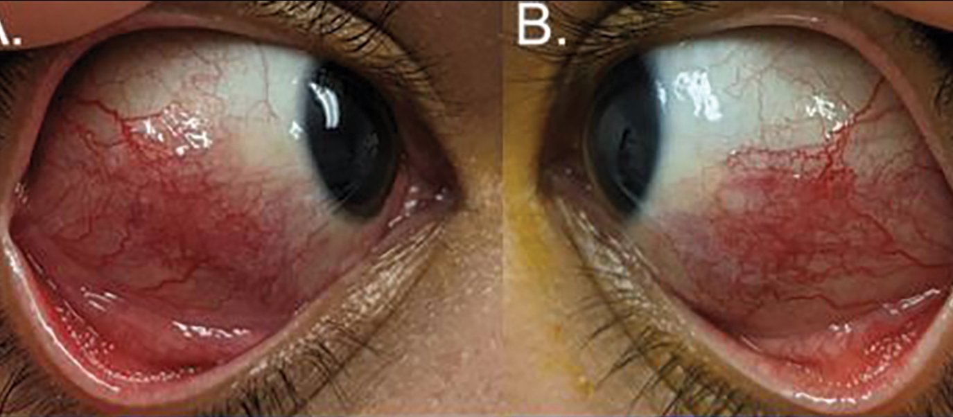 COVID-19 triggers eye scleritis: Patient study for rare eye-melting  complication of infection | New Zealand Doctor