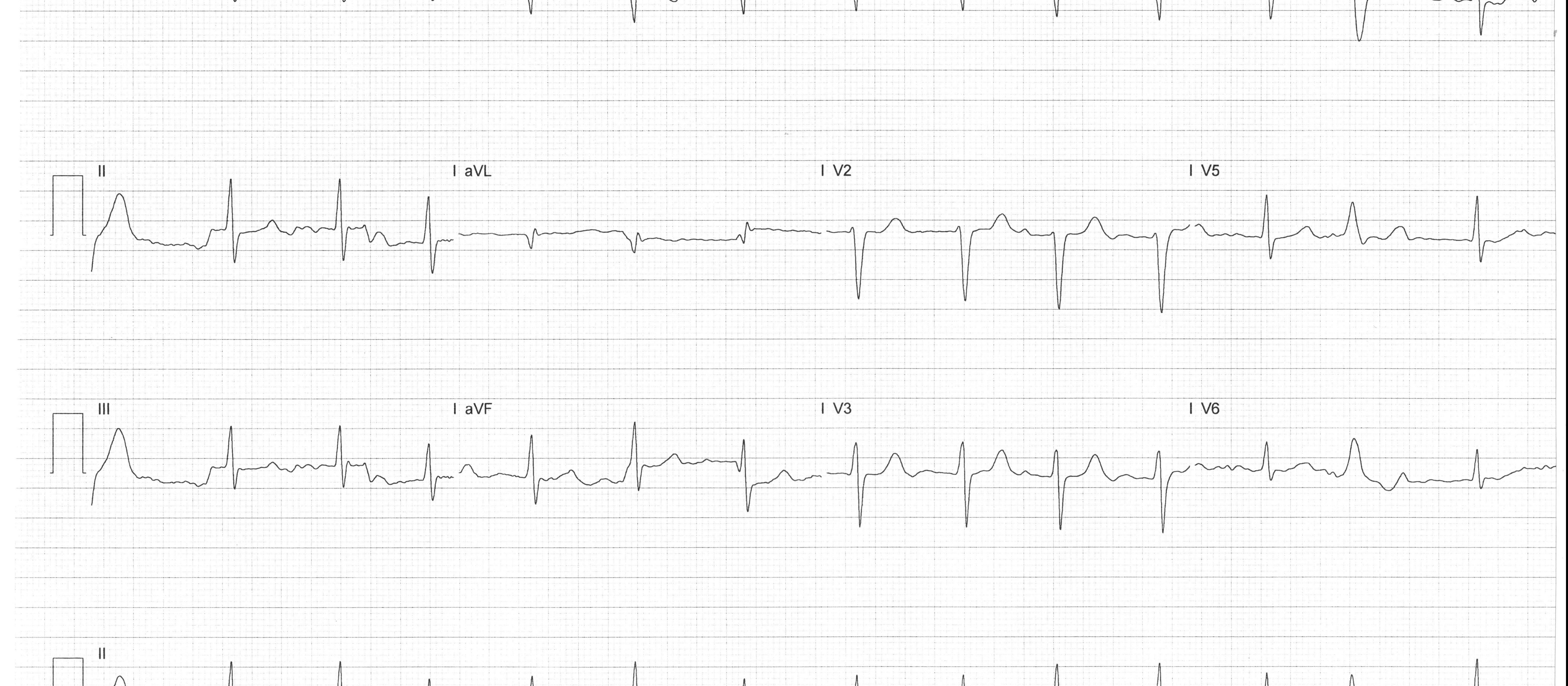 ECG