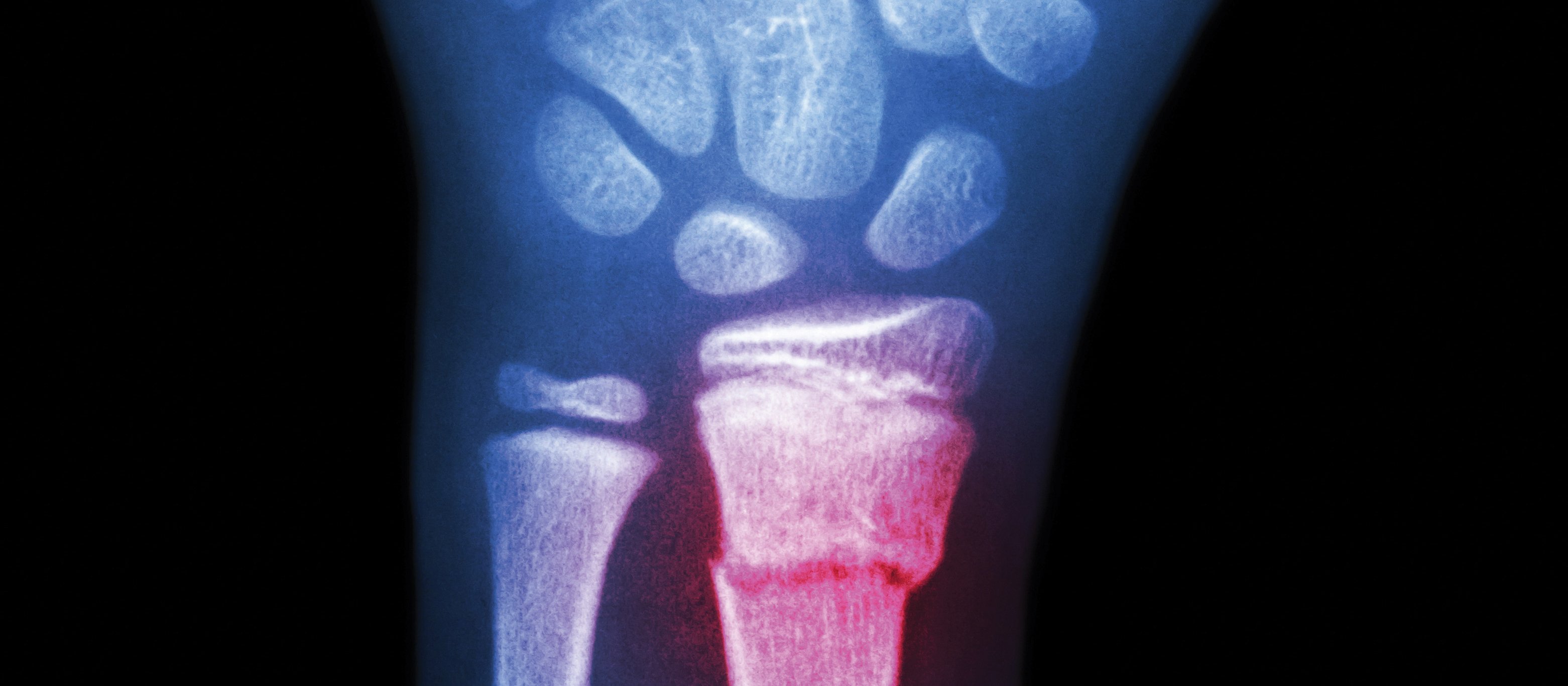 Broken wrist [Image: Stockdevil on iStock]