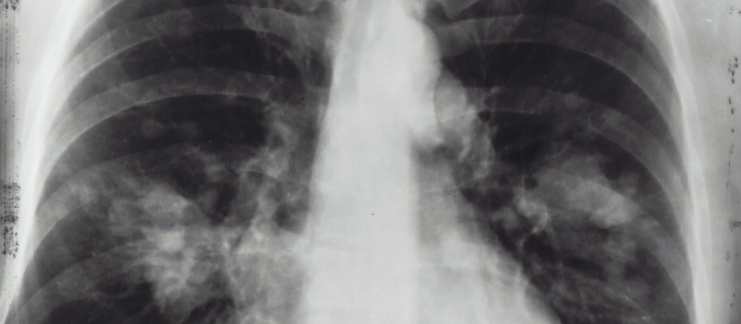 Chest X-Ray 