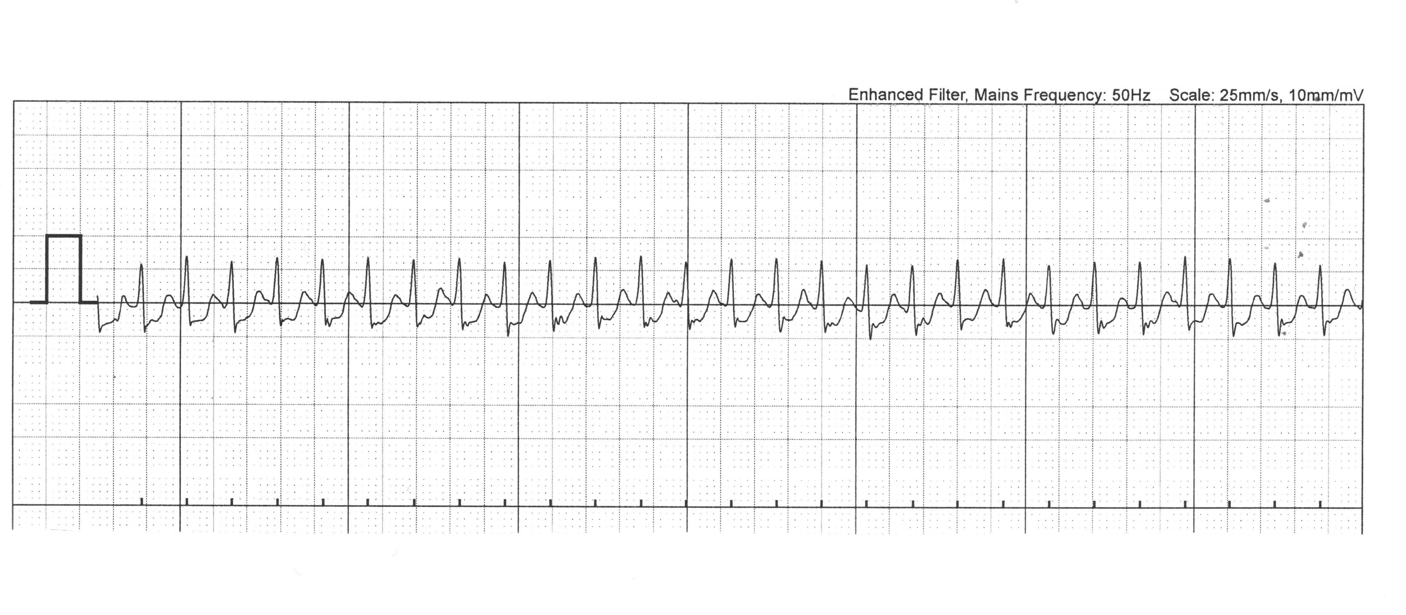 ECG