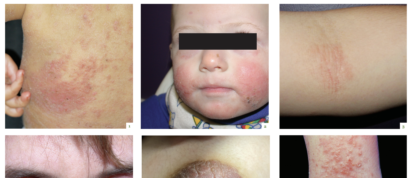 Dermatology