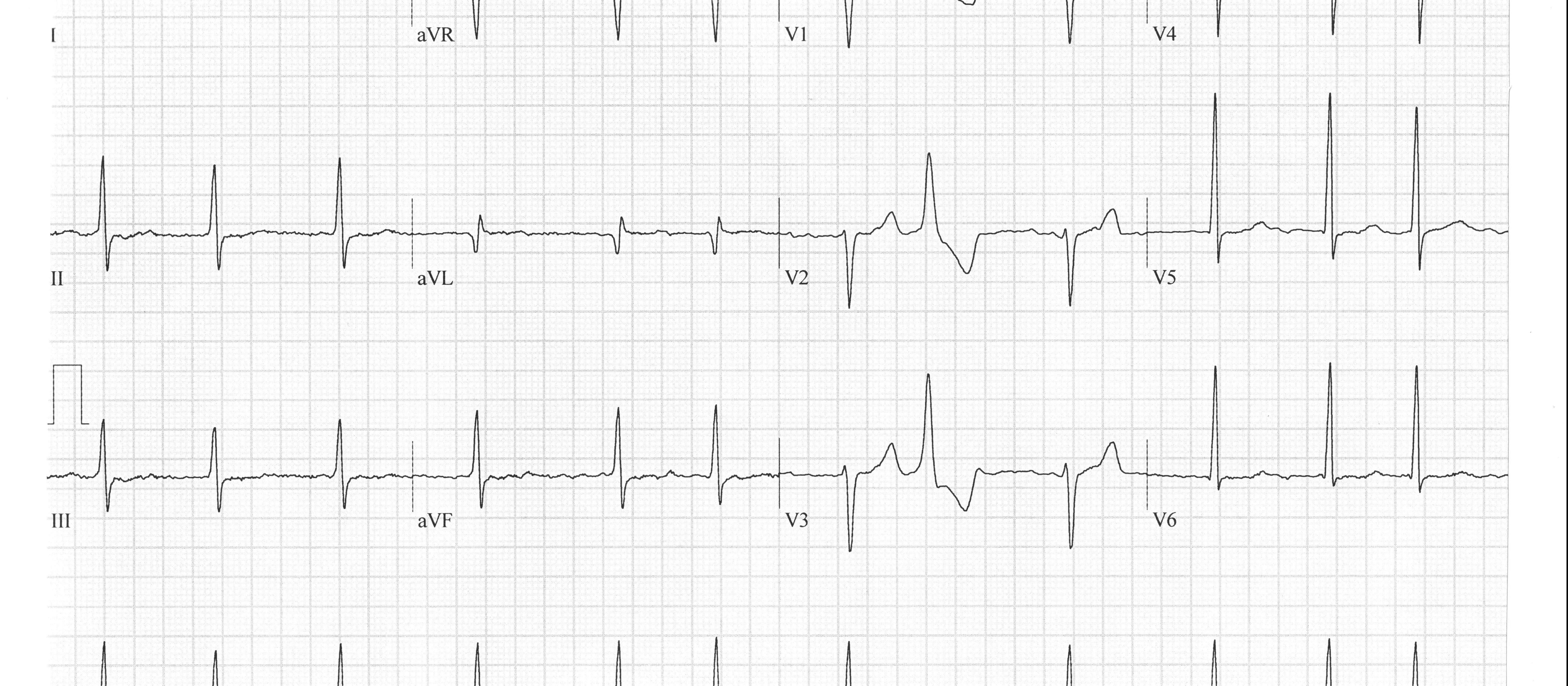 ECG