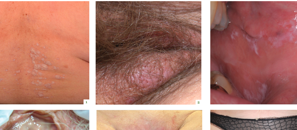 Dermatology Vulval Conditions Menopause
