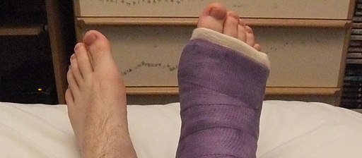 Leg cast