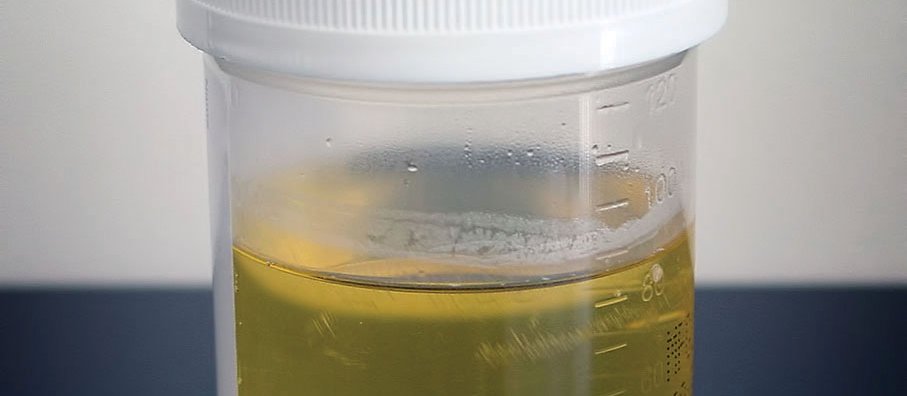 Urine sample