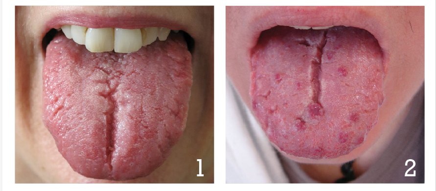 Tongue disease
