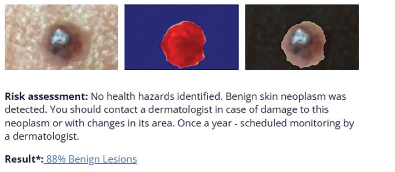 skin lesion scanning result