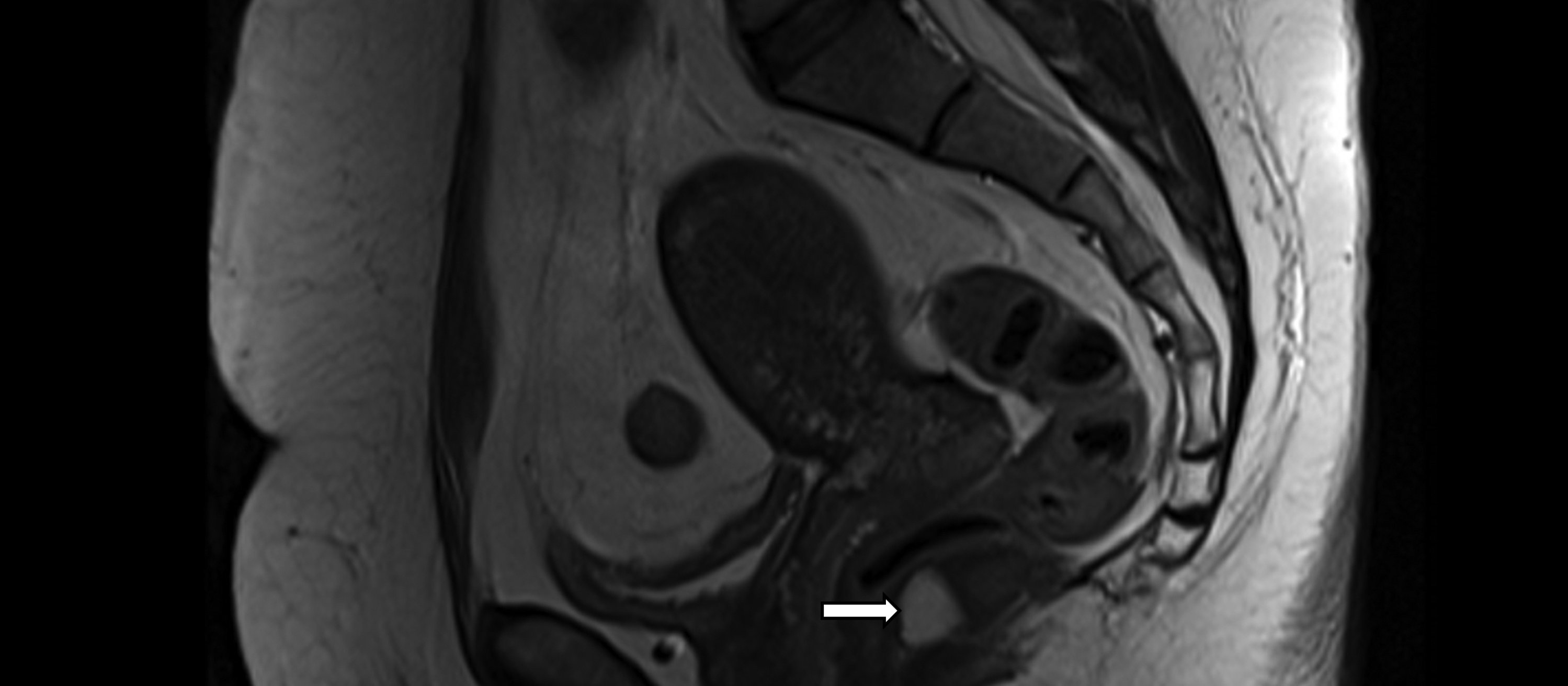 MRI