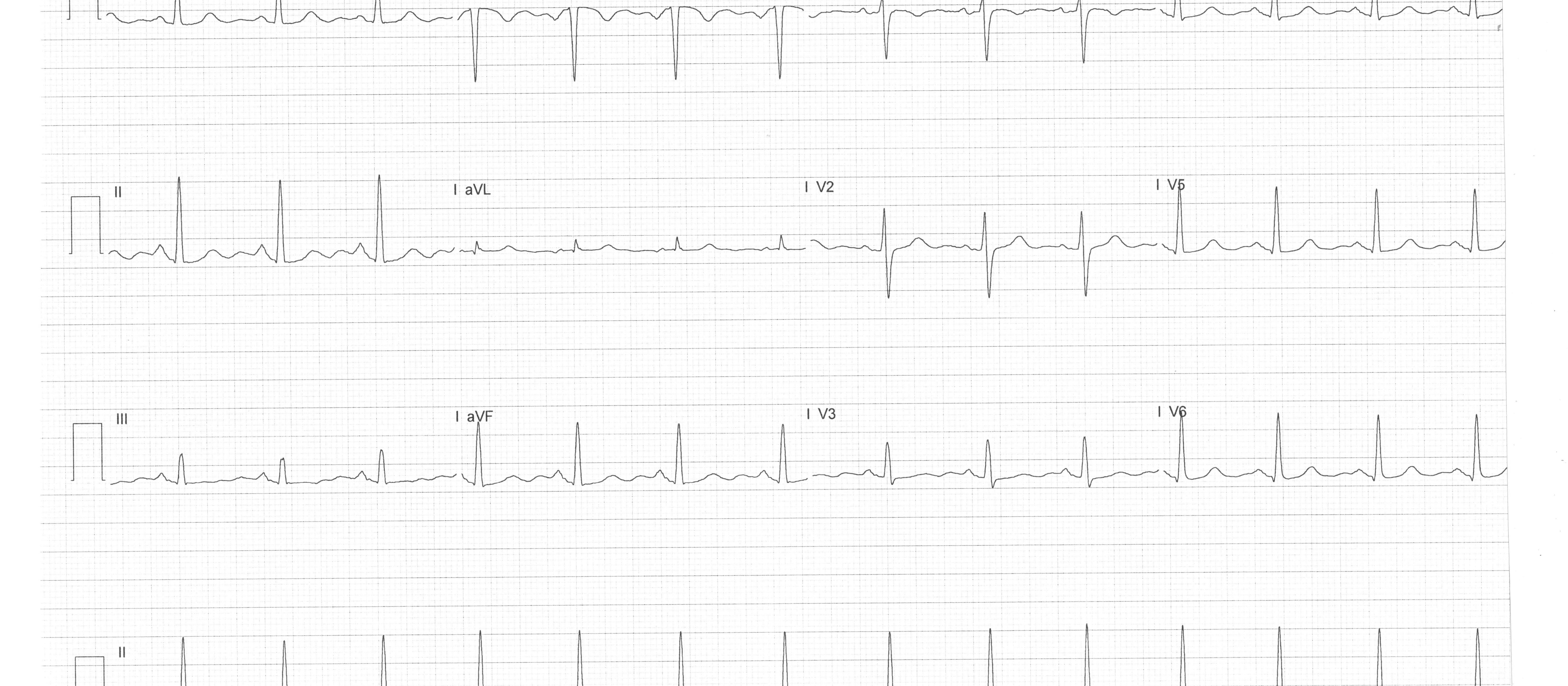 ECG