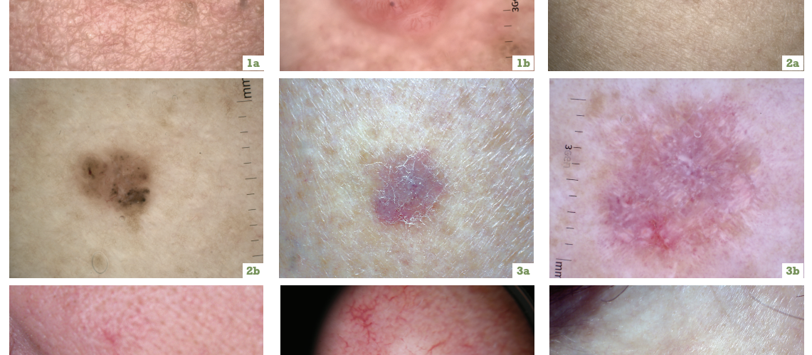 non-melanoma skin cancers