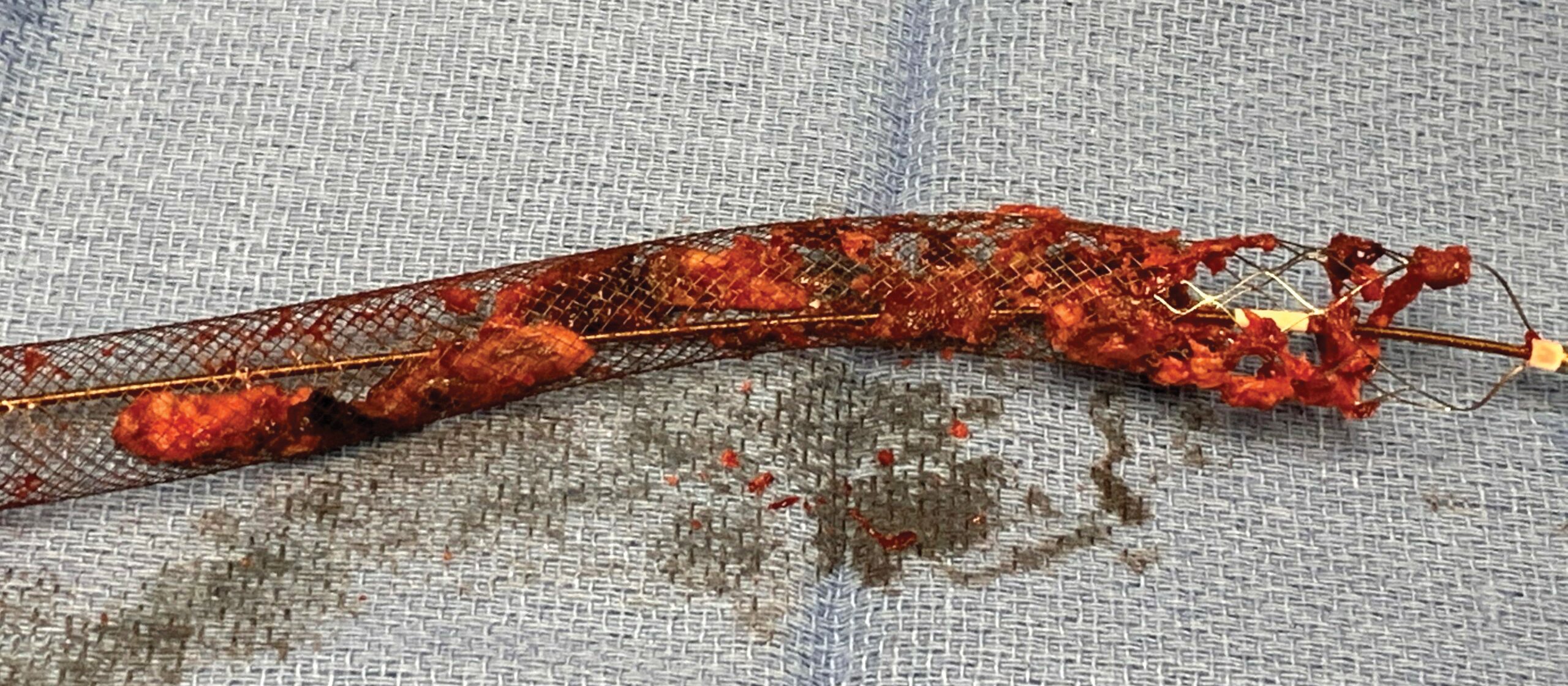 Blood clots in the ClotReiver CR Inari Medical