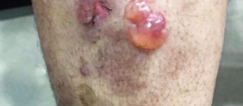 skin lesions become blisters