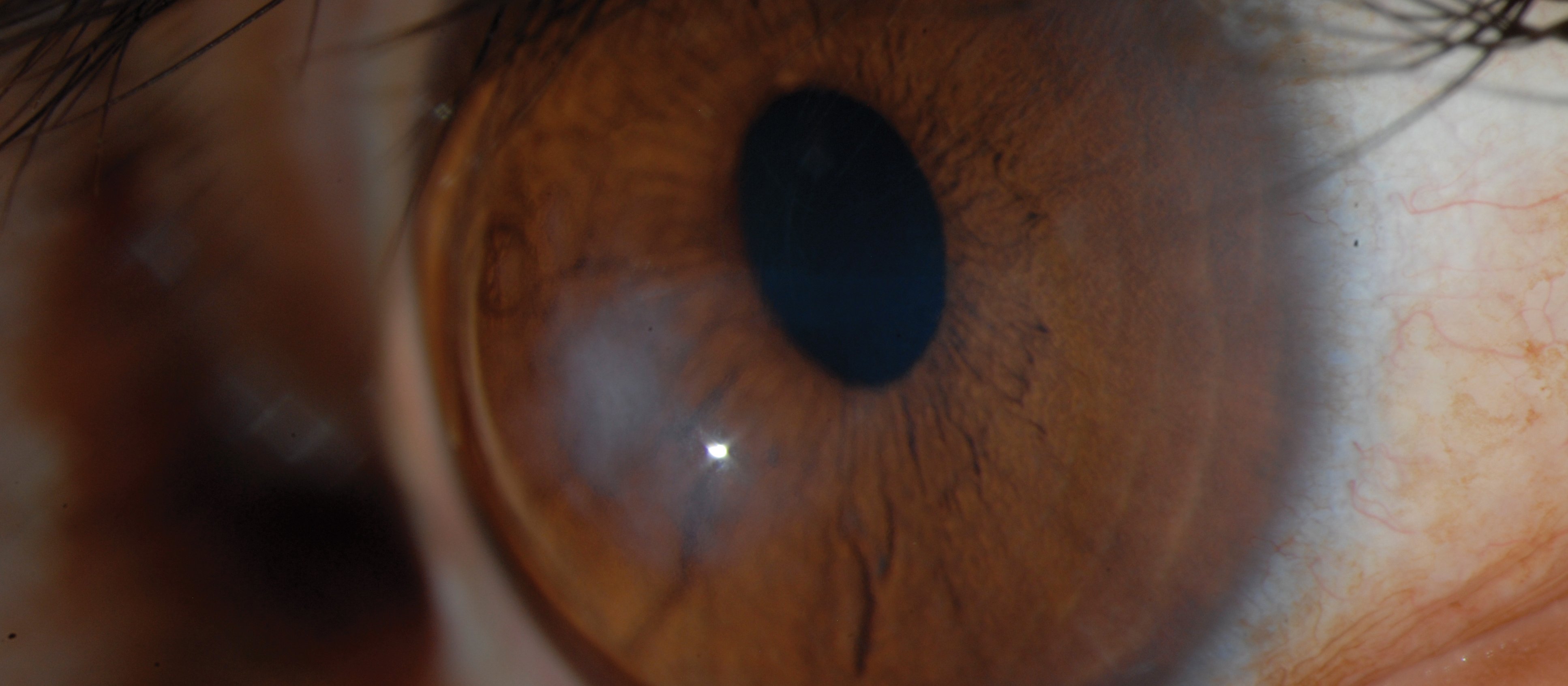 Eye