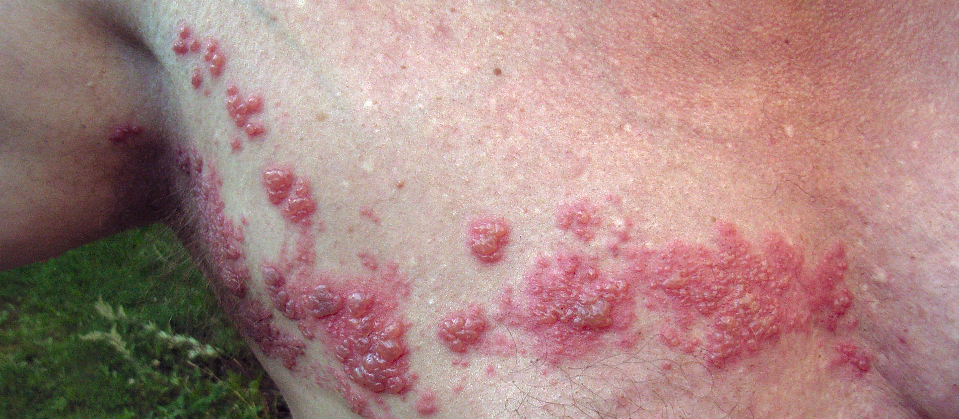 Herpes